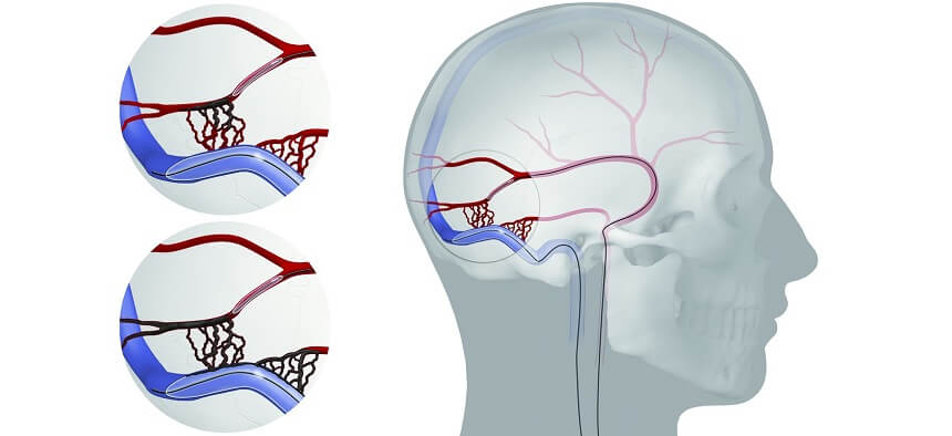 Brain Arteriovenous Fistula Embolization in Pune